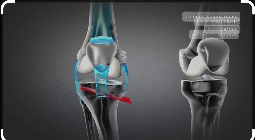 Arthroplastie totale de genou